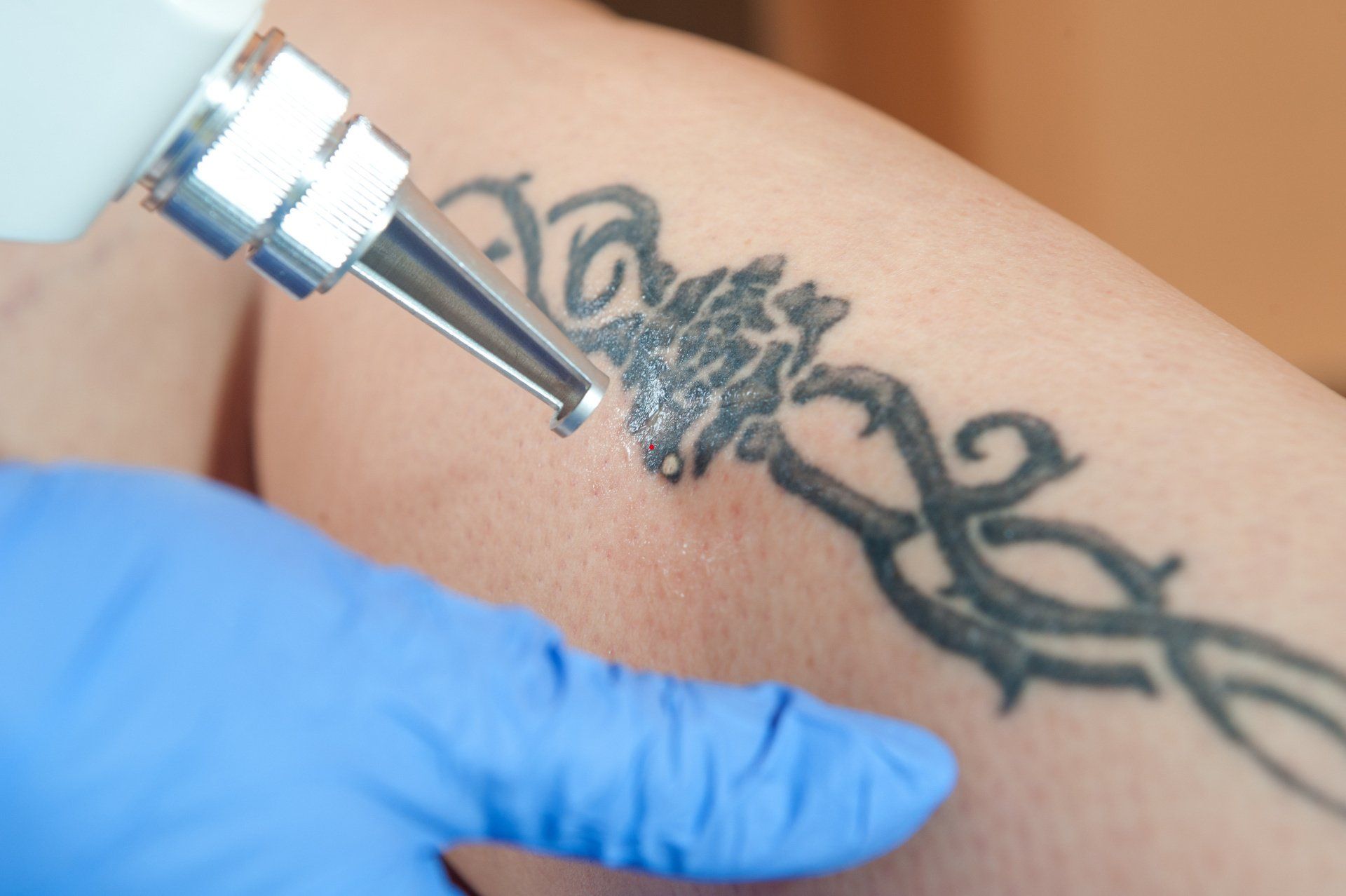 Entfernung eines Tattoos mit dem Laser