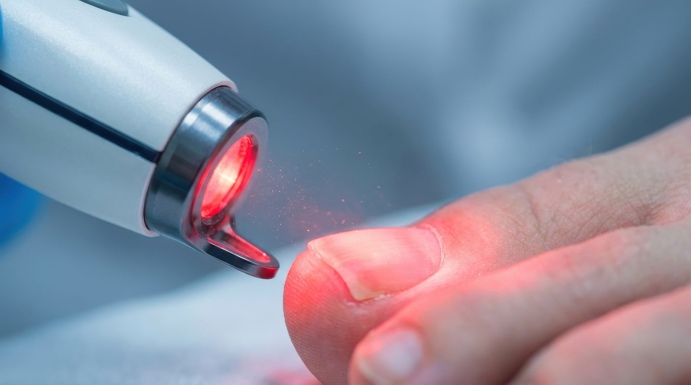 Laserbehandlung eines Zehennagels bei Nagelpilz